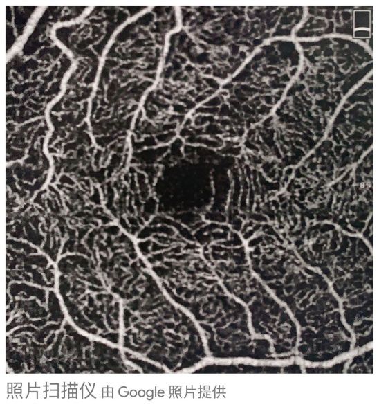 眼底黄斑病变一般多久会失明,眼底黄斑病的养护和注意事项