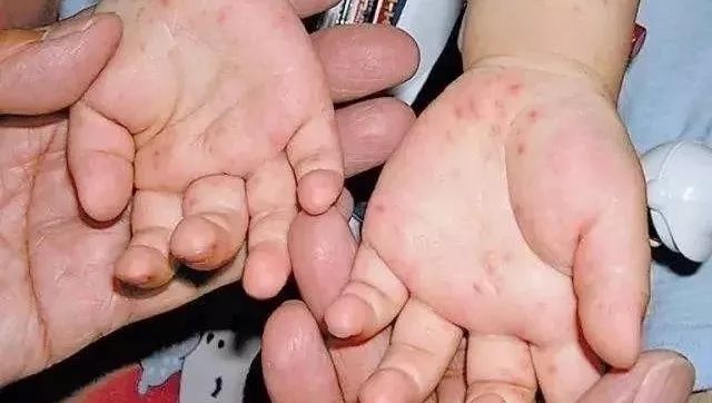 经常掉发的人有什么办法,经常掉发吃什么能改善