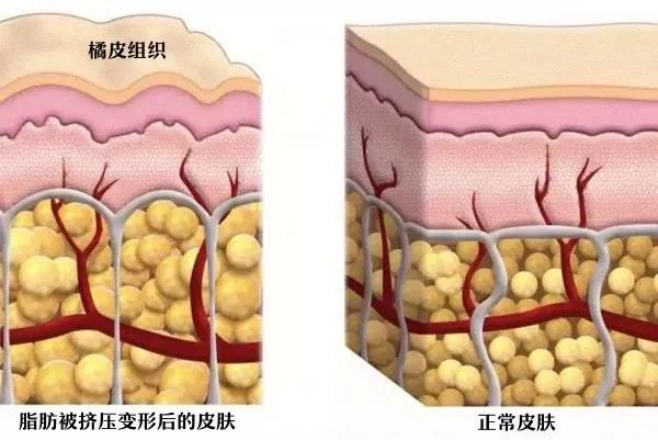 模特减肥一星期瘦二十斤,快速瘦肚子瘦腰懒人瘦身霜女