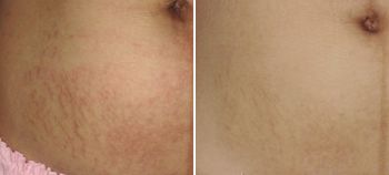 模特减肥一星期瘦二十斤,快速瘦肚子瘦腰懒人瘦身霜女