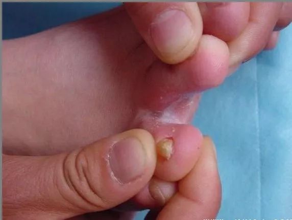 夏季脚气特别痒怎么办,夏天脚气高发怎么治疗