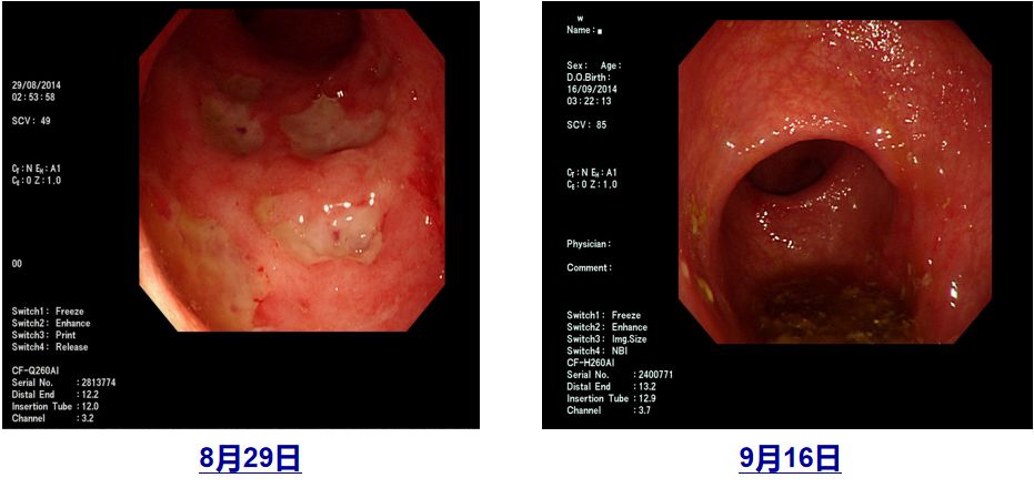 武汉协和医院治疗溃疡性结肠炎,北京协和医院溃疡性结肠炎专家