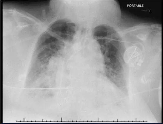 社区获得性肺炎患者完整病例,社区获得性肺炎的治疗图片