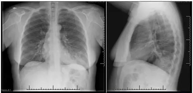 社区获得性肺炎患者完整病例,社区获得性肺炎的治疗图片