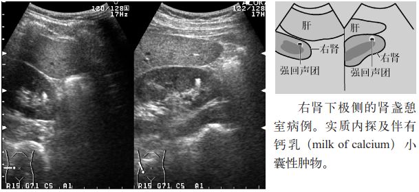 肾结石图片输尿管结石症状,输尿管上段结石超声碎石危害大么