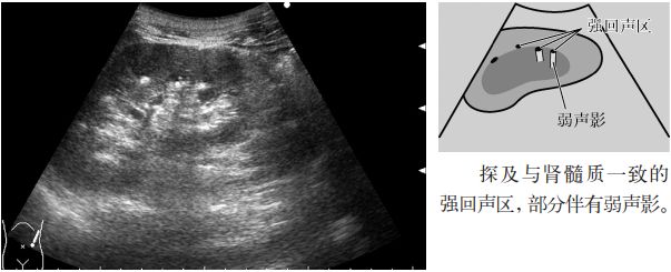 肾结石图片输尿管结石症状,输尿管上段结石超声碎石危害大么