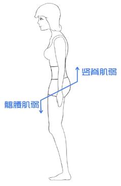 骨盆前倾医学解释,骨盆后倾引起腰痛康复