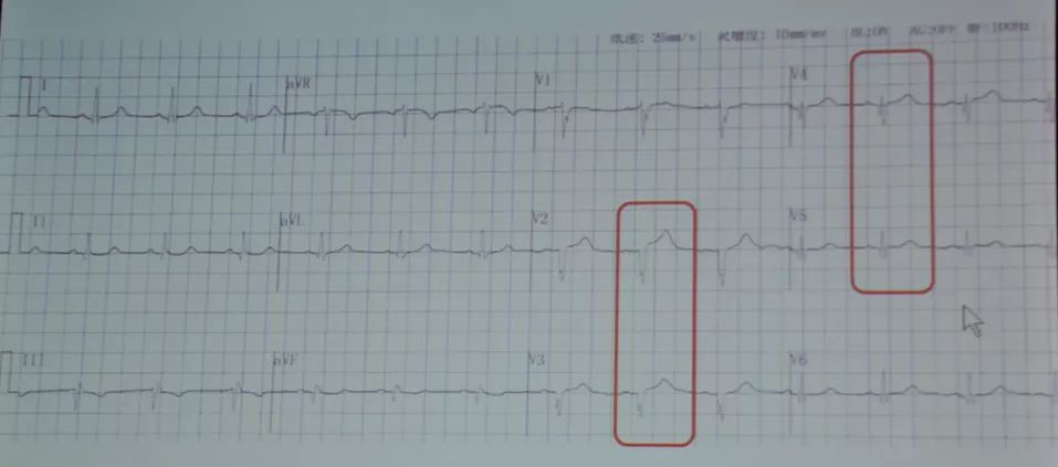 冠脉痉挛的诊疗分析,冠脉痉挛的临床诊断方法