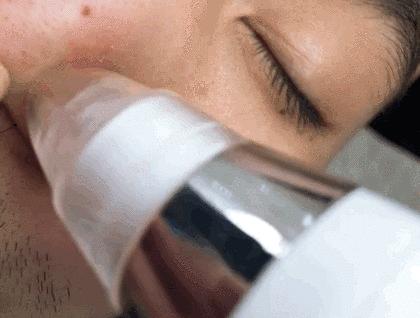 草莓鼻救星怎么治疗,草莓鼻去黑头神器视频