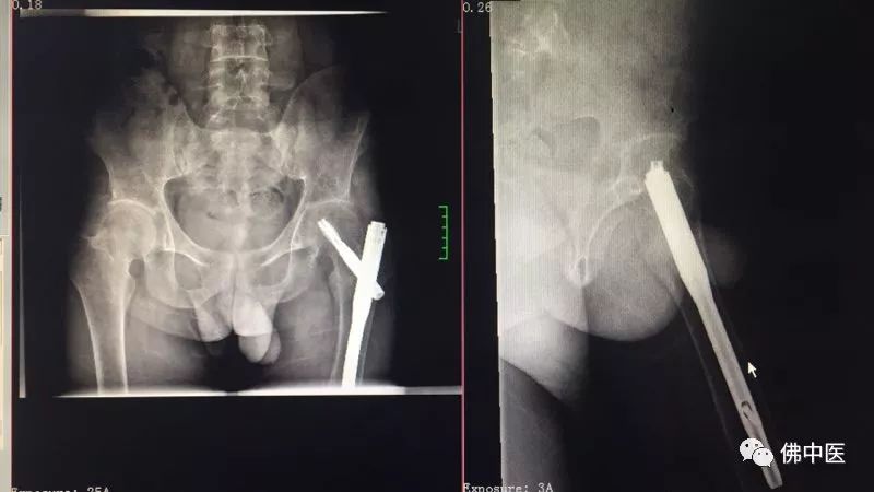 骨质破坏和骨癌诊断,怪病全身肿瘤