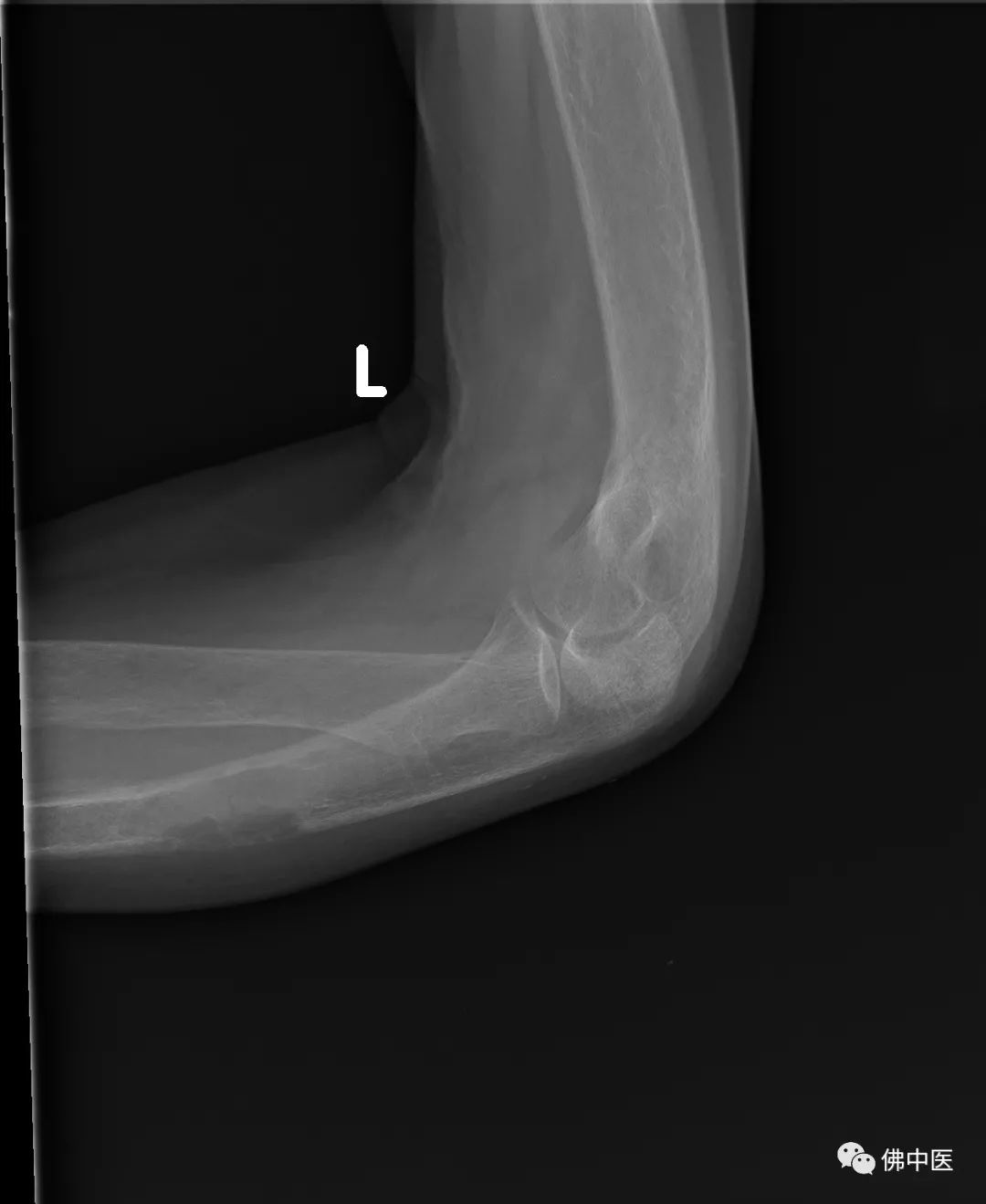 骨质破坏和骨癌诊断,怪病全身肿瘤