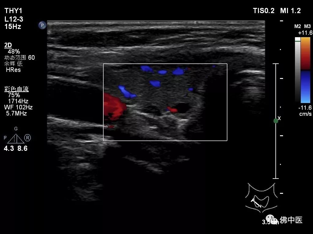 骨质破坏和骨癌诊断,怪病全身肿瘤