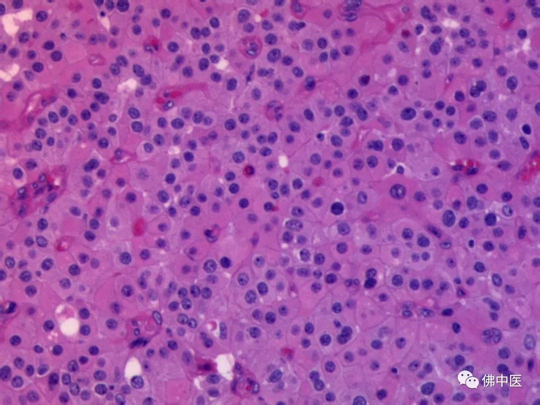 骨质破坏和骨癌诊断,怪病全身肿瘤