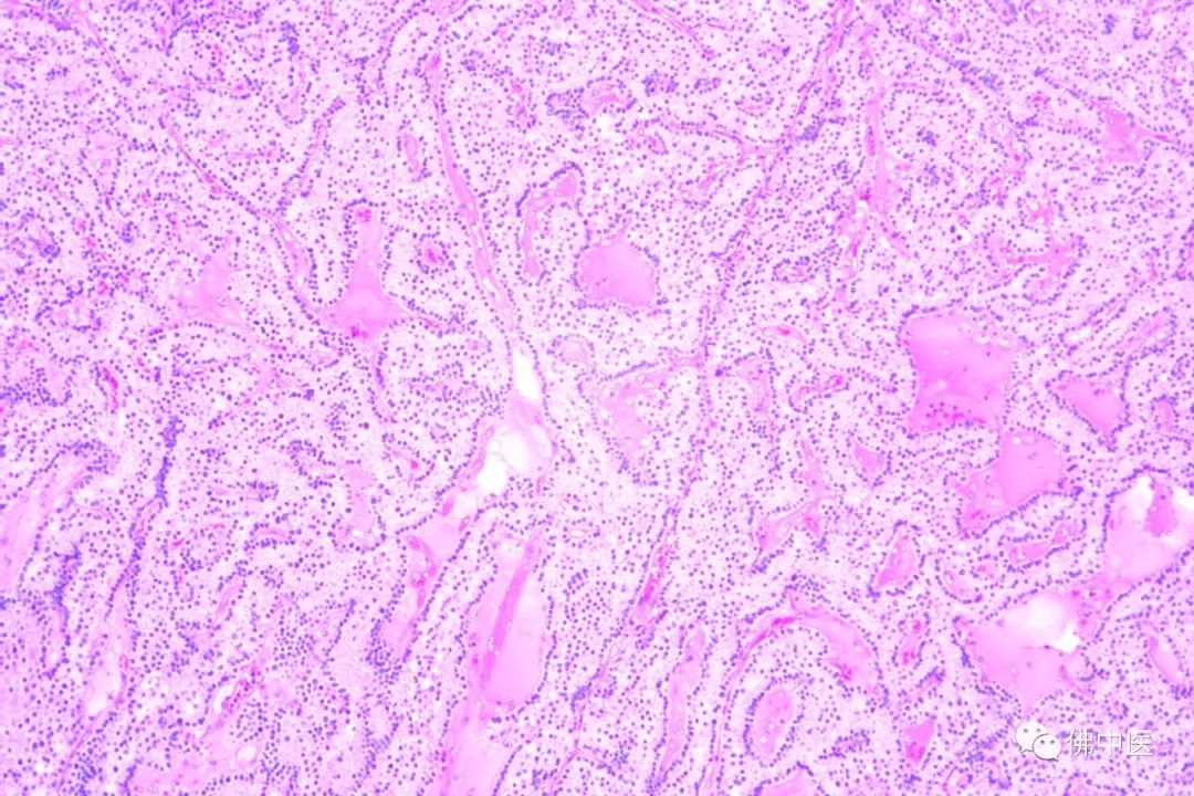 骨质破坏和骨癌诊断,怪病全身肿瘤