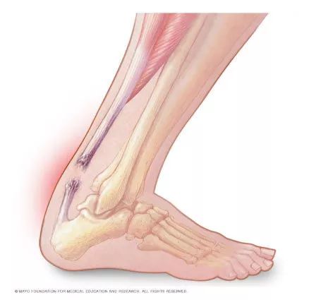 杜兰特跟腱断裂为什么还那么厉害,杜兰特跟腱断裂重回赛场