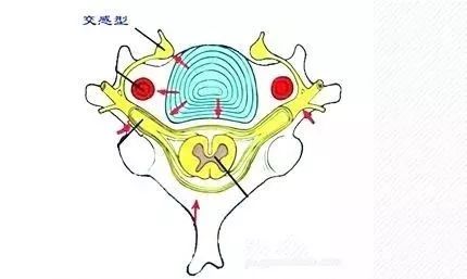 交感神经型颈椎病手术,交感神经型颈椎病会猝死吗