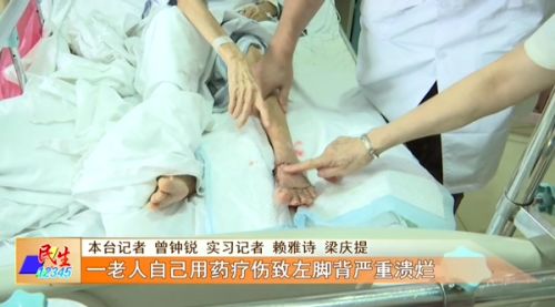 一老人腿溃烂,老人脚背皮肤溃烂