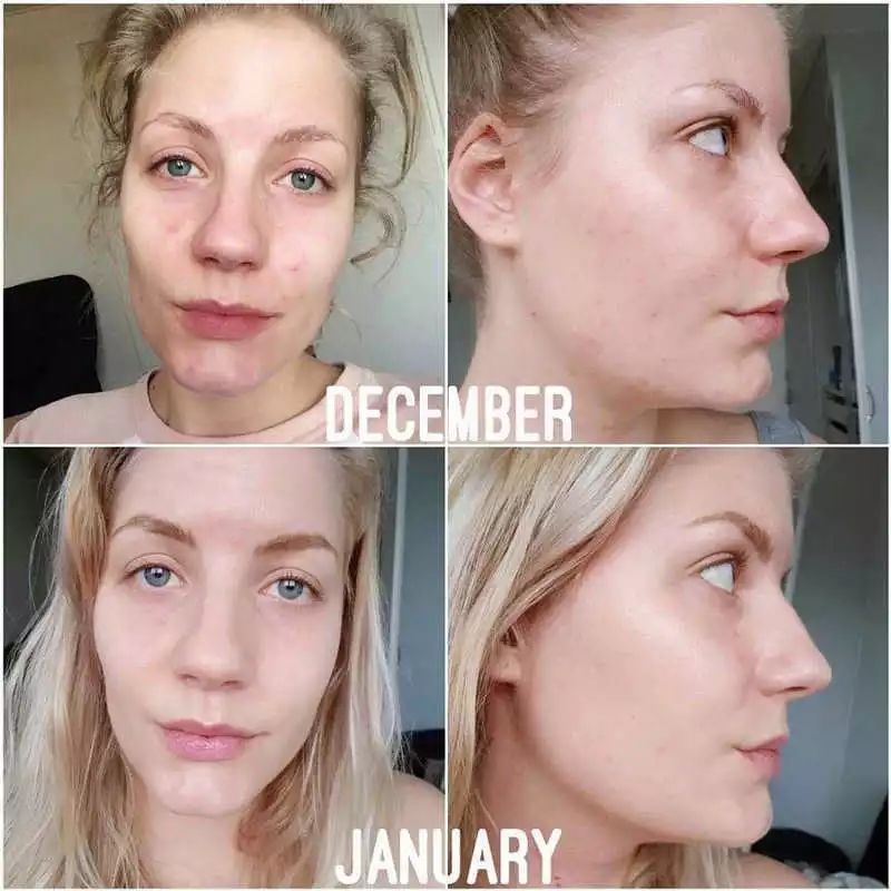 皮肤粗糙暗沉毛孔粗要做什么医美,真正改变毛孔的医美