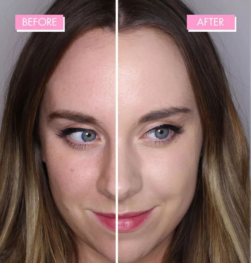 皮肤粗糙暗沉毛孔粗要做什么医美,真正改变毛孔的医美