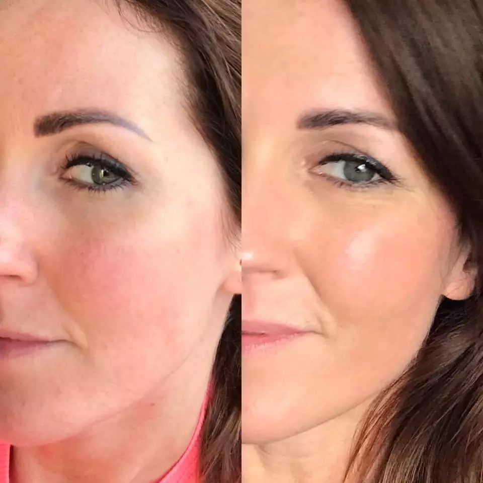 皮肤粗糙暗沉毛孔粗要做什么医美,真正改变毛孔的医美