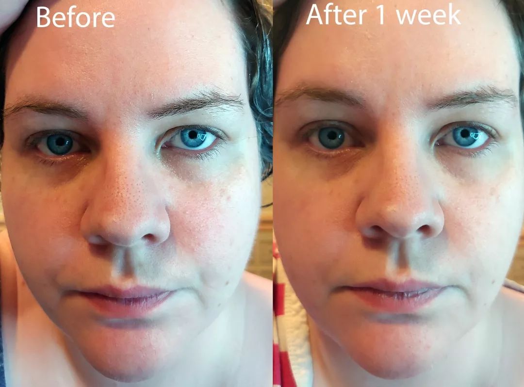 皮肤粗糙暗沉毛孔粗要做什么医美,真正改变毛孔的医美