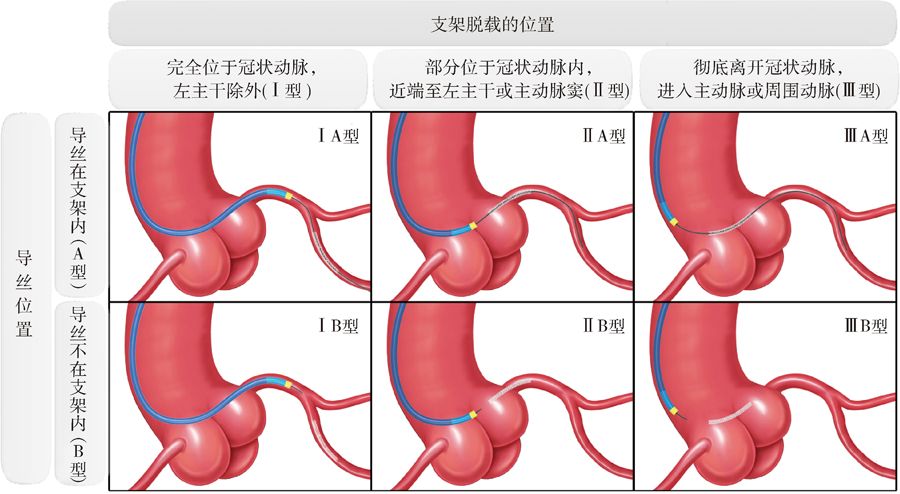 冠脉支架抗凝治疗专家共识,冠状动脉破裂的处理方法