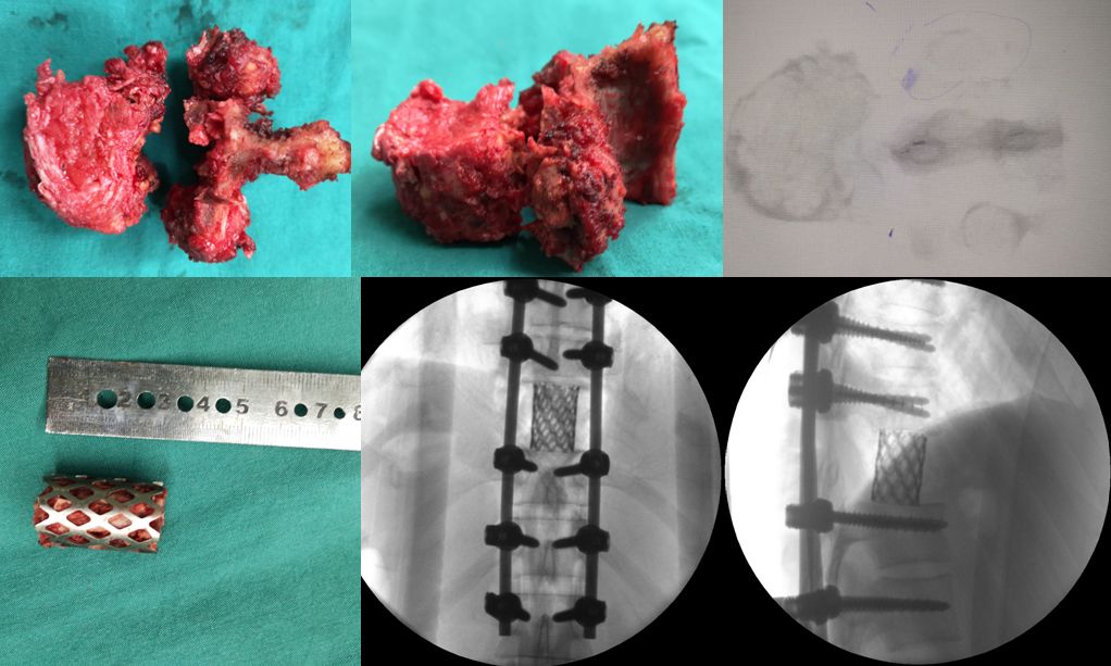 筋骨堂筋膜刀,筋骨堂整脊