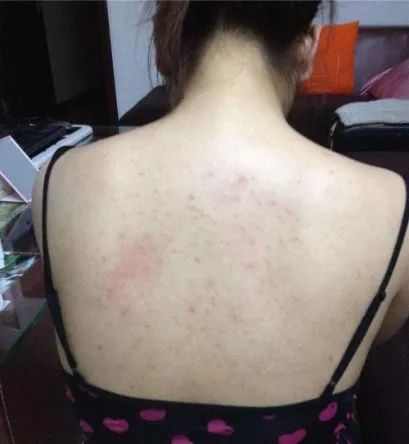 鸡皮肤怎么穿露背装,短期内快速去除鸡皮肤