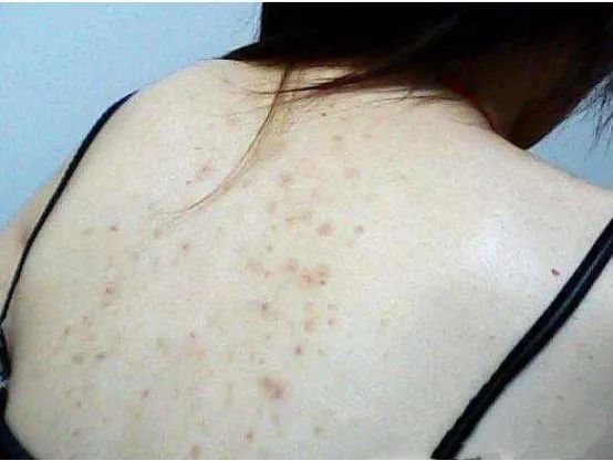 鸡皮肤怎么穿露背装,短期内快速去除鸡皮肤