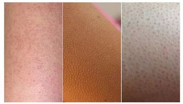 鸡皮肤怎么穿露背装,短期内快速去除鸡皮肤