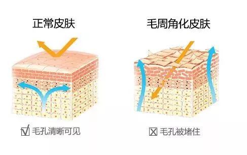鸡皮肤怎么穿露背装,短期内快速去除鸡皮肤