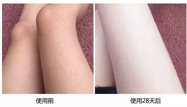 鸡皮肤怎么穿露背装,短期内快速去除鸡皮肤