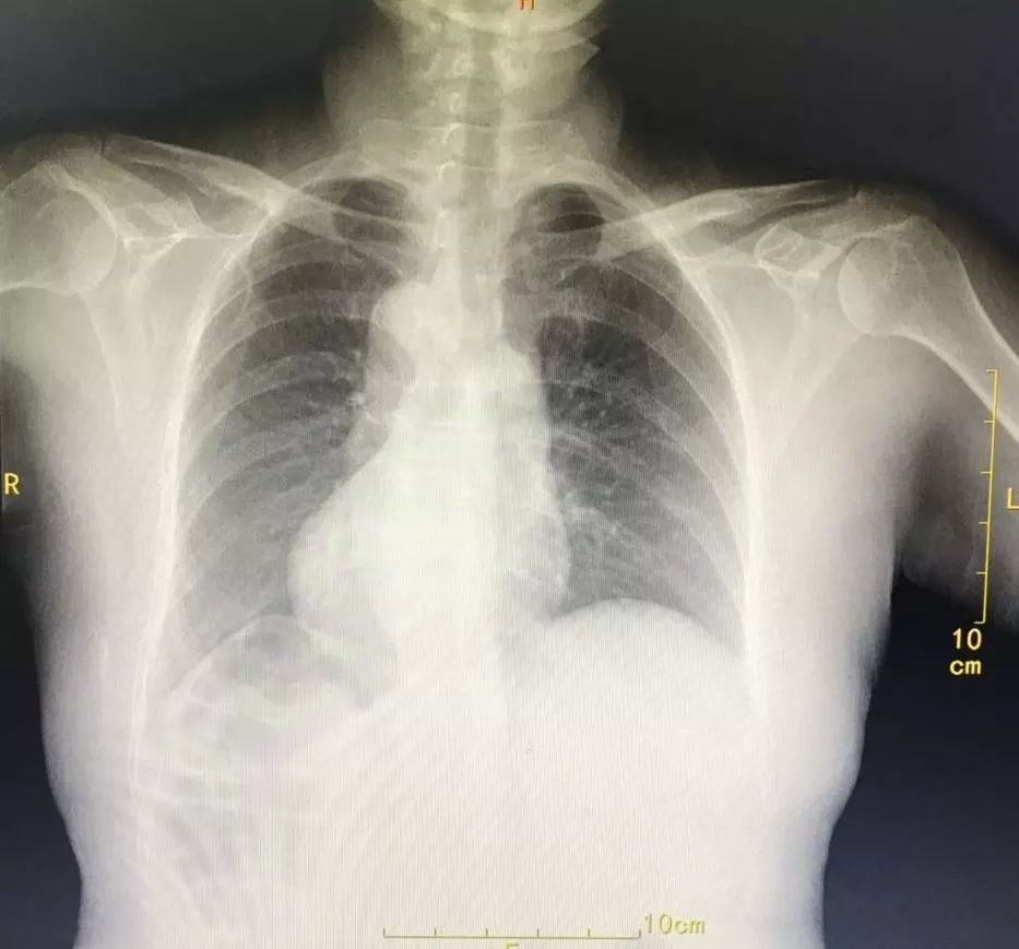 镜面人内脏移植,镜面人胆囊切除