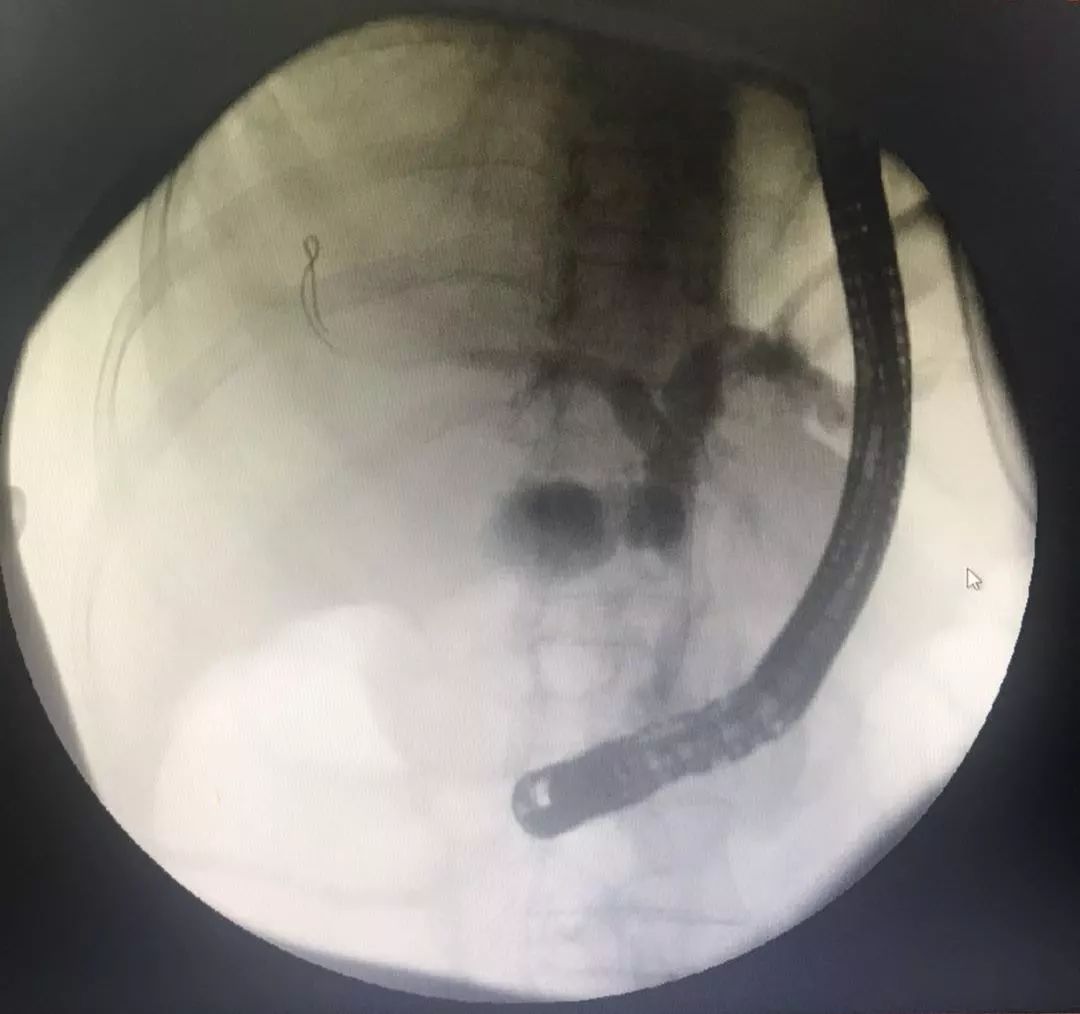 镜面人内脏移植,镜面人胆囊切除