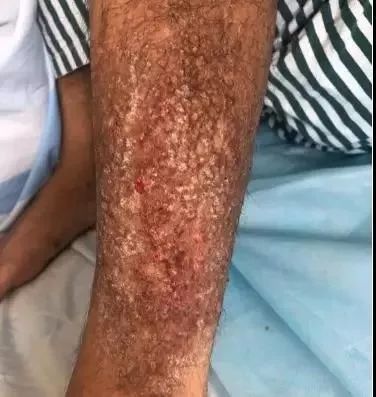 一男子用民间偏方治病险送命!这些偏方都是血淋淋的教训,千万别信