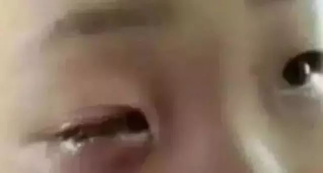 男孩眼球溶化的危害,男孩眼球被溶化是怎么回事