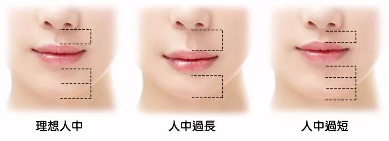 人中缩短还可以变回去吗,人中缩短值得做吗