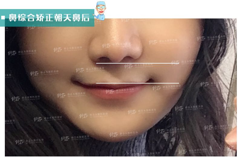 人中缩短还可以变回去吗,人中缩短值得做吗