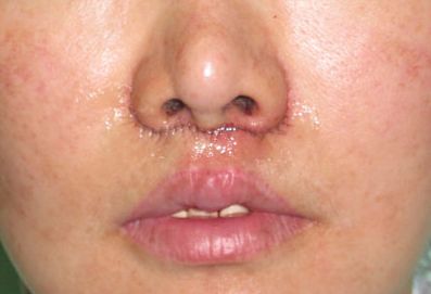 人中缩短还可以变回去吗,人中缩短值得做吗