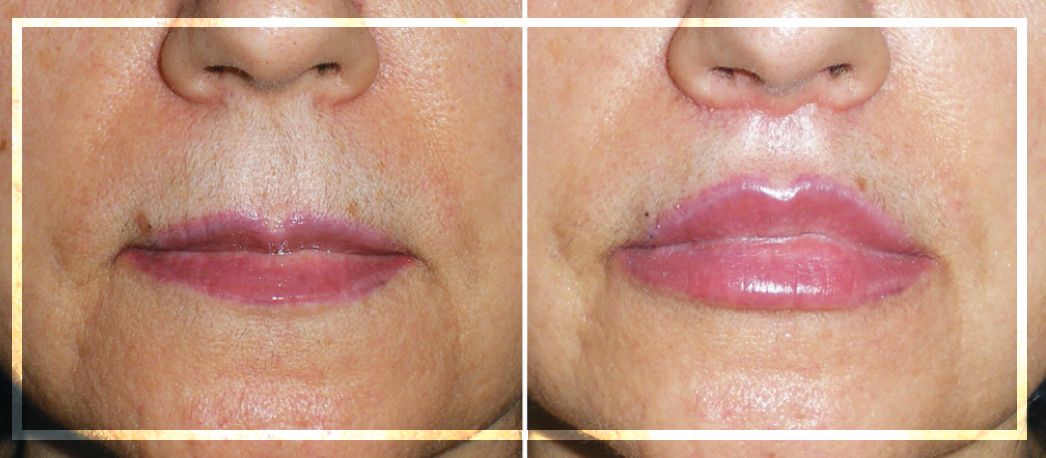 人中缩短还可以变回去吗,人中缩短值得做吗