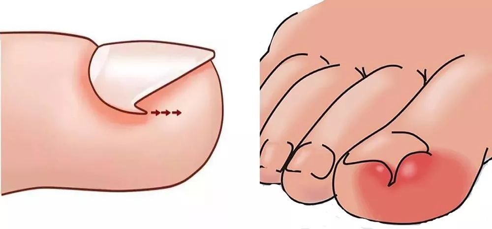 专业医生修甲沟炎,军医在线保护牙齿预防牙外伤