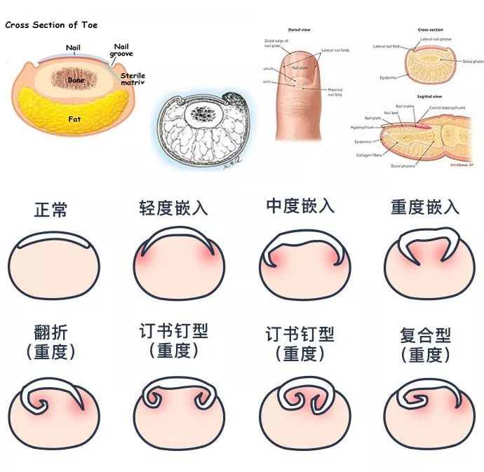 专业医生修甲沟炎,军医在线保护牙齿预防牙外伤