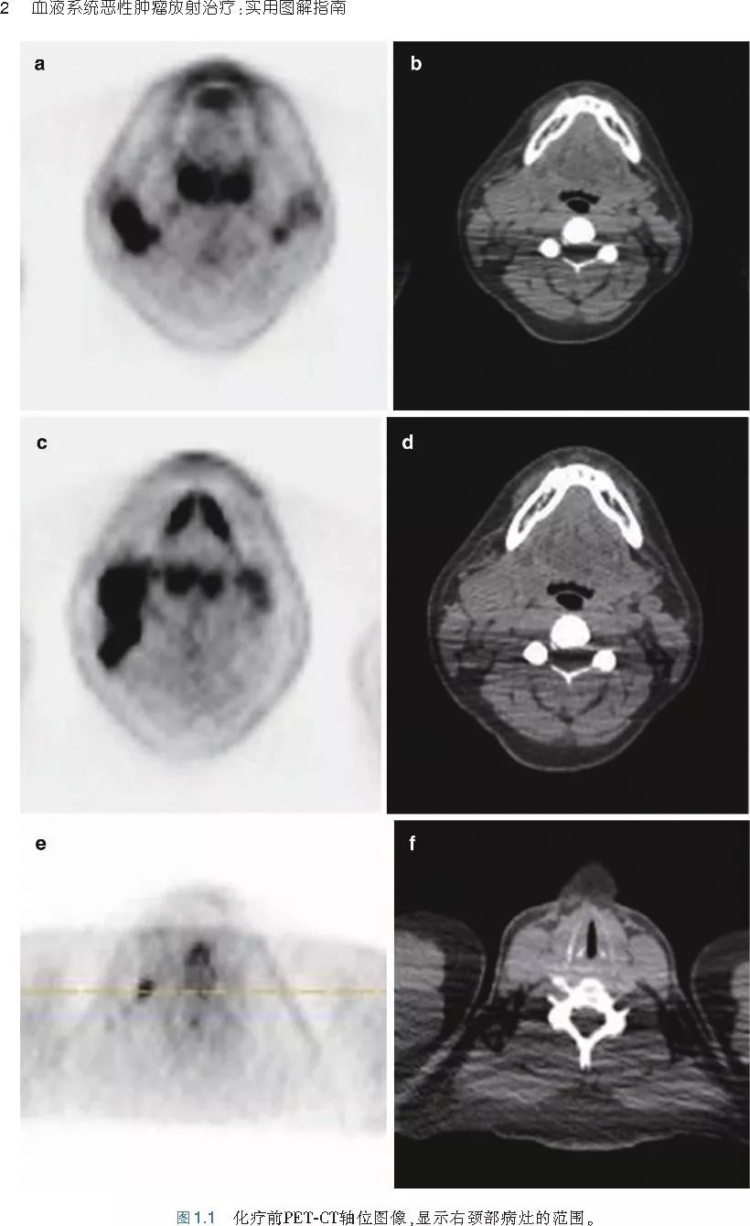 血液系统恶性肿瘤放射治疗：实用图解指南