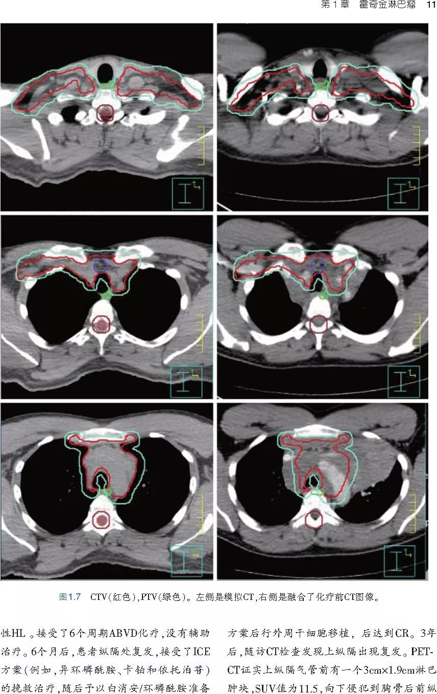 血液系统恶性肿瘤放射治疗：实用图解指南