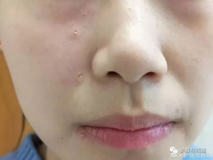 遮痣最简单的方法,褐青色痣的治疗方法