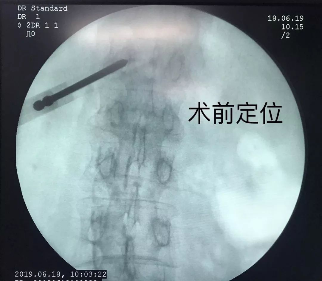 骨科科普压缩性骨折,陈旧性压缩骨折和新近压缩骨折