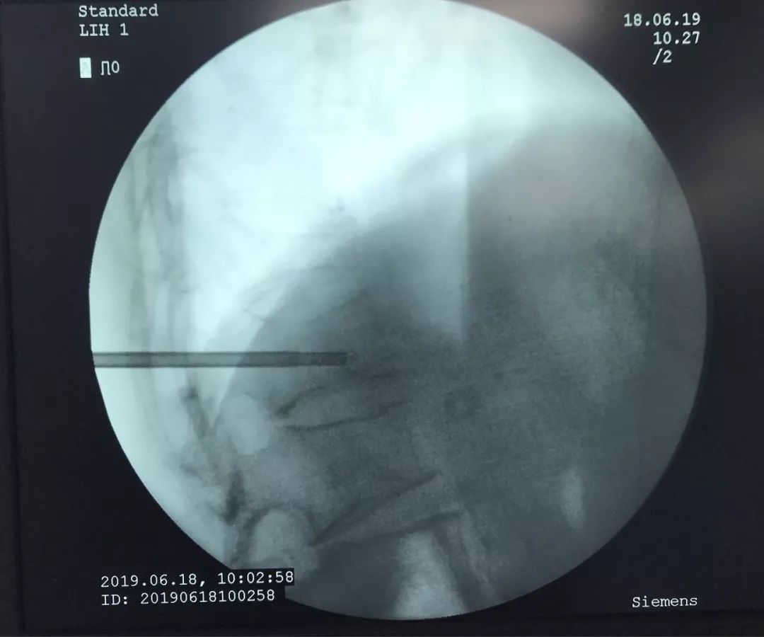 骨科科普压缩性骨折,陈旧性压缩骨折和新近压缩骨折