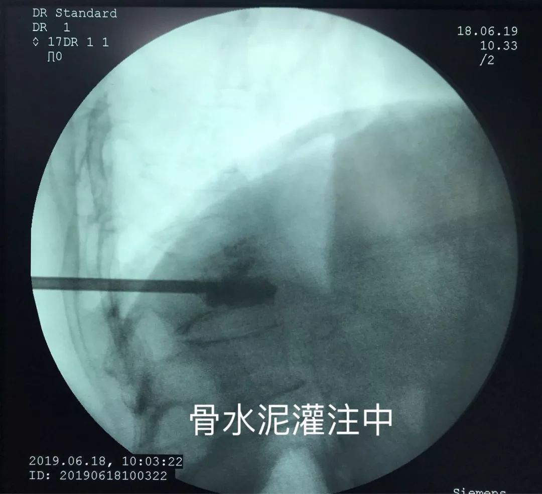 骨科科普压缩性骨折,陈旧性压缩骨折和新近压缩骨折