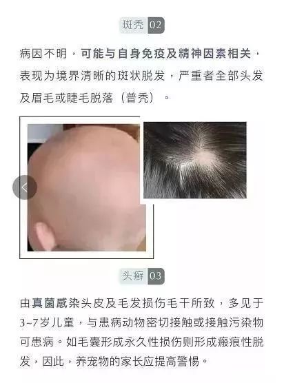 4岁女孩头发几乎掉光，头皮流脓！原因竟和家里这个有关