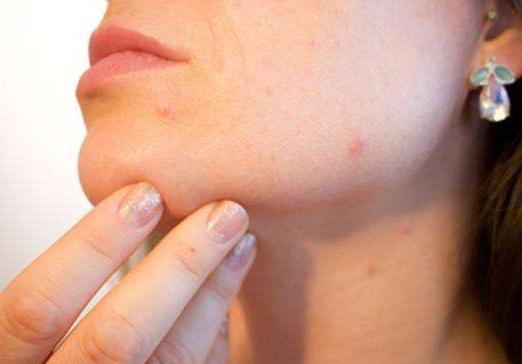 治疗蚊虫叮咬最好偏方,防治蚊虫叮咬的最好方法